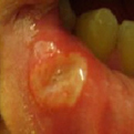 Aphthous Ulcers1