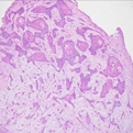 Basal Cell Carcinoma1