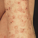 Dermatitis Herpetiformis2