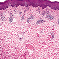 Erythema Annulare Centrifugum2