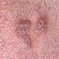 Granuloma Faciale1