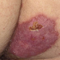 Majocchi's Granuloma1