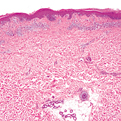 Mycosis Fungoides2