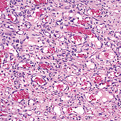 Pyogenic Granuloma2
