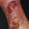 Stasis Dermatitis2