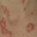 Systemic Lupus Erythematosus1