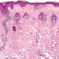 Systemic Lupus Erythematosus2