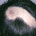Alopecia Areata2