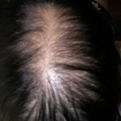 Androgenetic Alopecia1