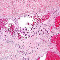 Glomus Tumors1