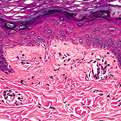 Lichen Amyloidosis2