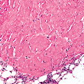 Lichen Sclerosus Et Atrophicus1