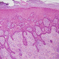 Squamous Cell Carcinoma1