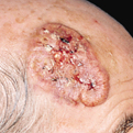 Squamous Cell Carcinoma2
